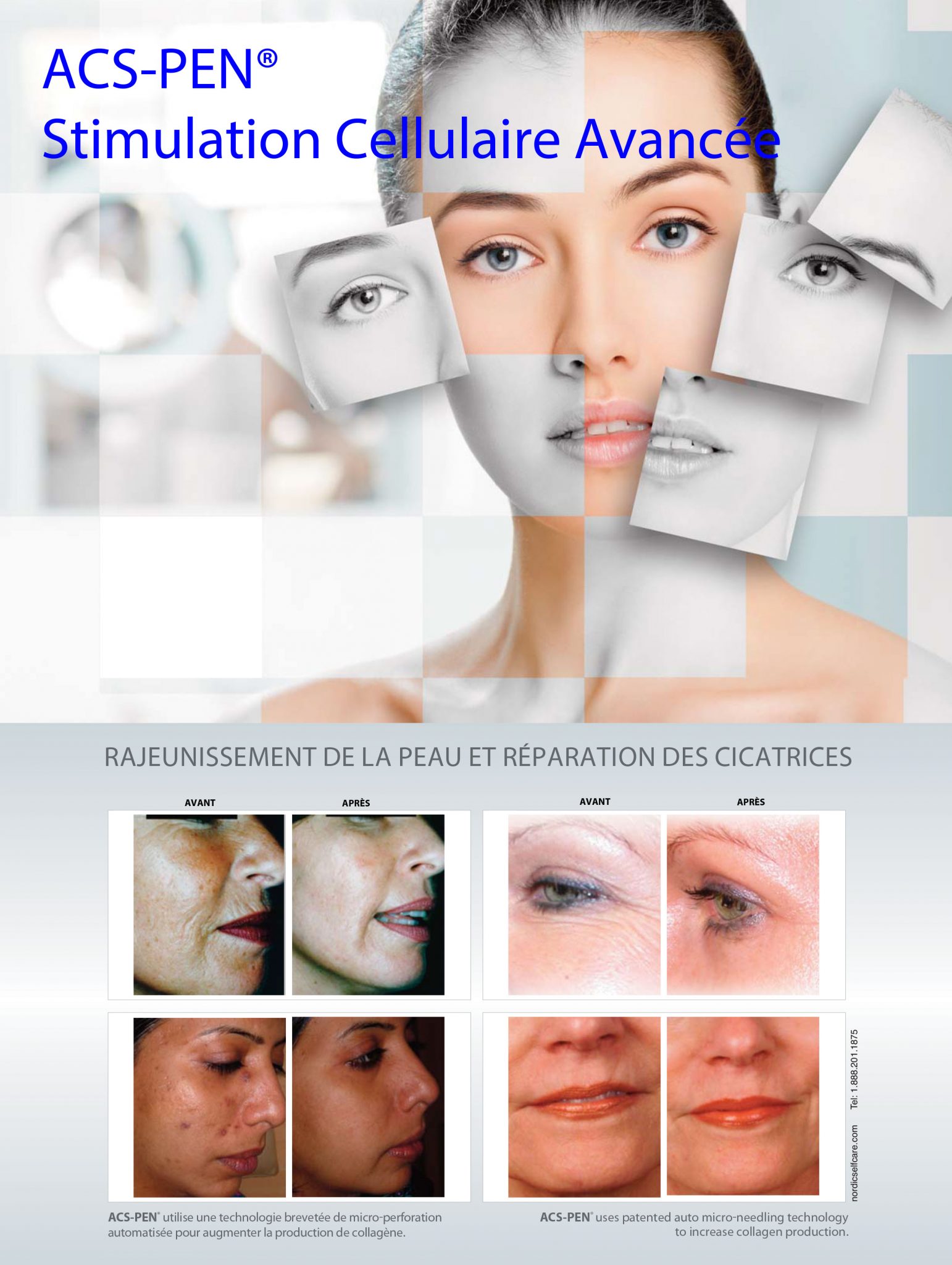 affiche-acs-pen-micro-aiguillage-maison-de-beaute-julie